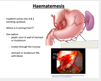 Haematemesis