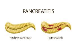 Pancreatitis