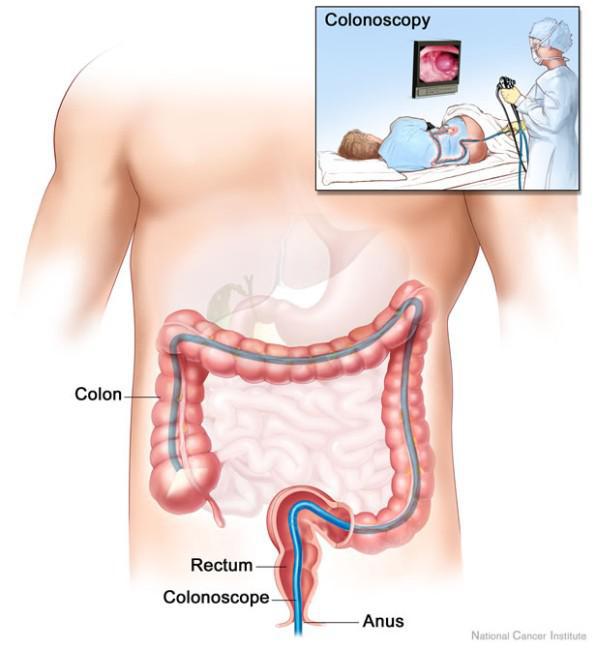 Bleeding Per Rectum