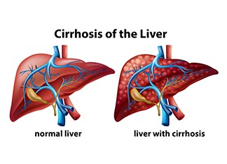 Cirrhosis Liver