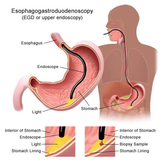 Endoscopic Biopsy